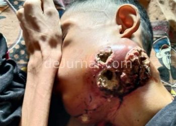 Paguyuban Sundawani Bantu Pasien Kanker Lidah Asal Pakenjeng