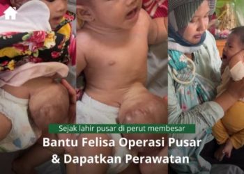 Baznas Ciamis Buka Donasi untuk Bayi Felisha, Derita Pusar Membesar Butuh Biaya Operasi 40 Juta