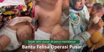 Baznas Ciamis Buka Donasi untuk Bayi Felisha, Derita Pusar Membesar Butuh Biaya Operasi 40 Juta